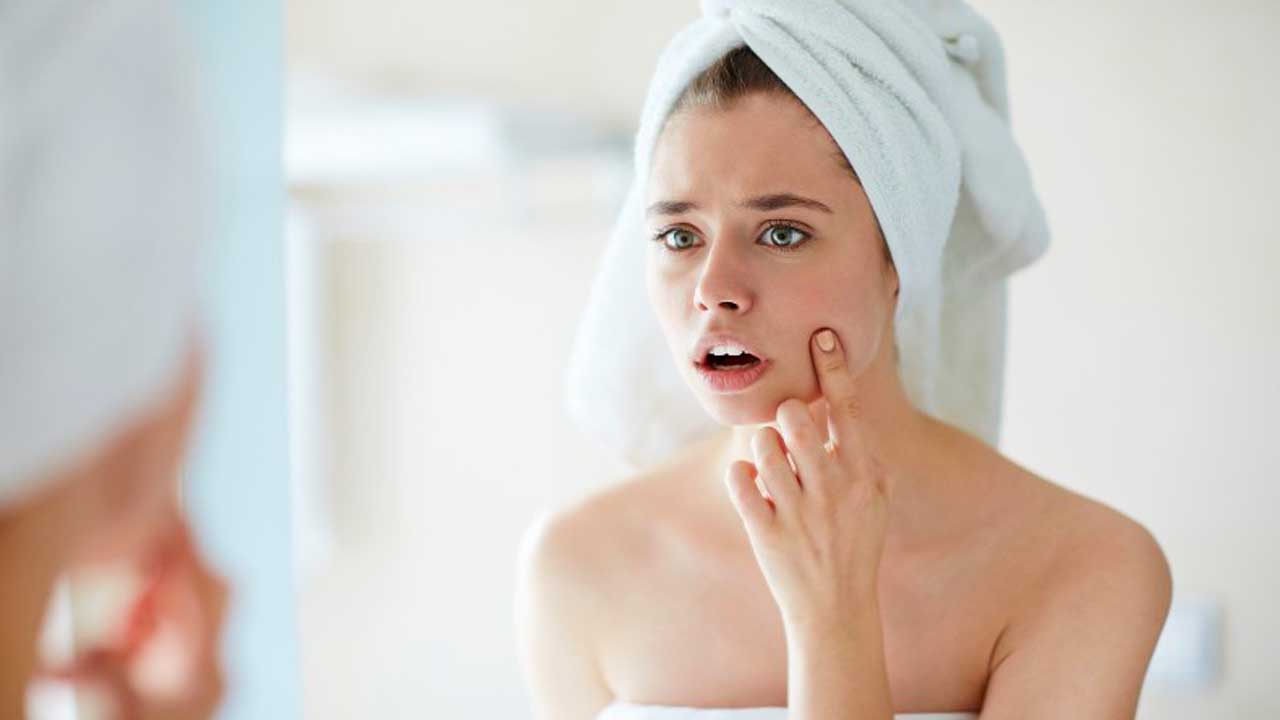 9 Things to Keep in Mind Before Treating Pimples