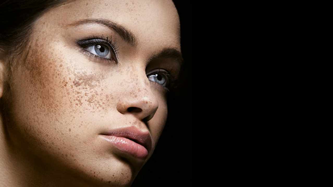 Everything You Need to Know About Melasma, Can it be cured?