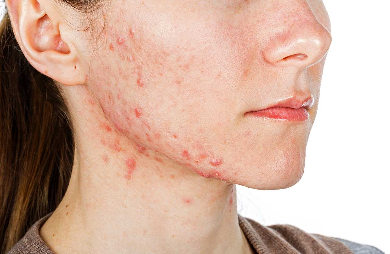 6 Types of Acne and Pimple Scars and its Treatments
