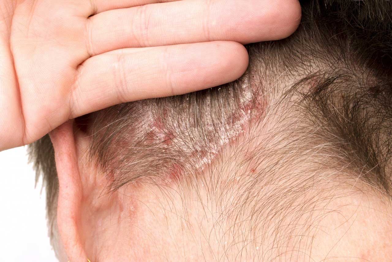 Psoriasis Causes, Symptoms, Types and Treatment