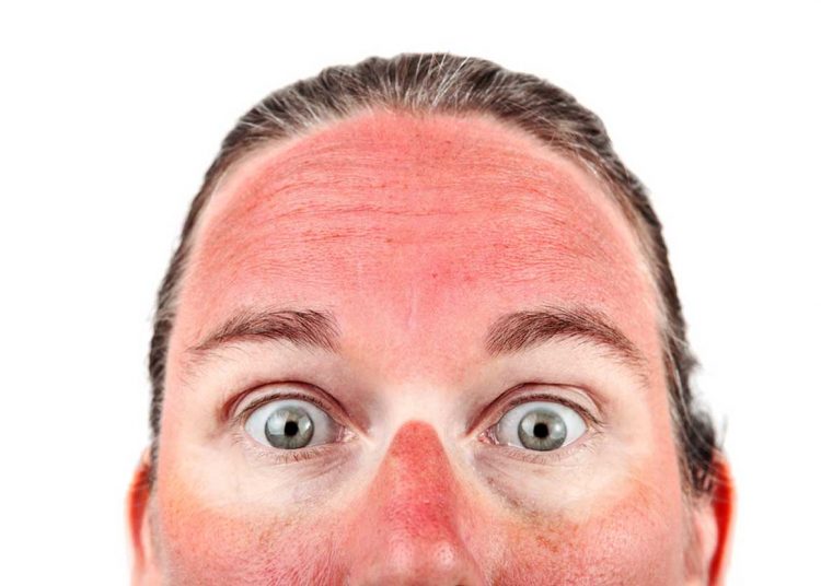 Top 09 Natural Ways to Treat and Cure Sunburns