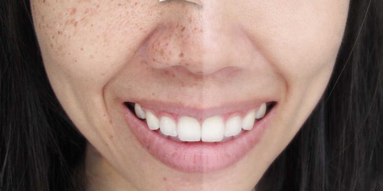 Best Home Remedies To Reduce Your Age Spots