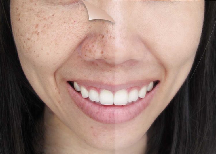 Best Home Remedies To Reduce Your Age Spots