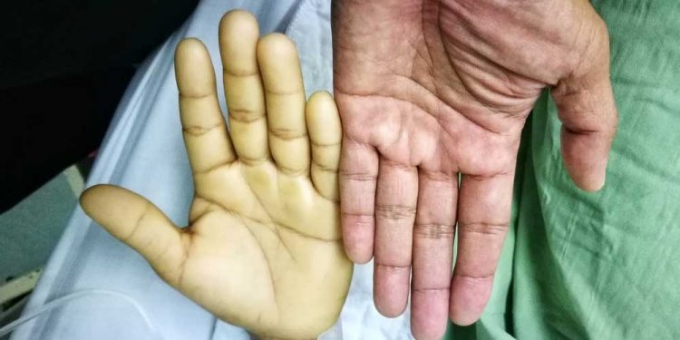 10 Effective and Natural Remedies to Get Rid of Anemia