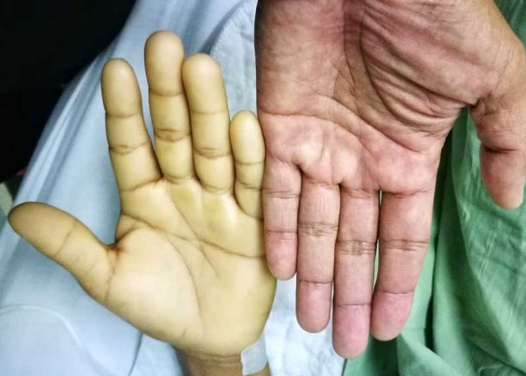 10 Effective and Natural Remedies to Get Rid of Anemia