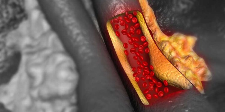 16 Ways to Naturally Reduce High Cholesterol