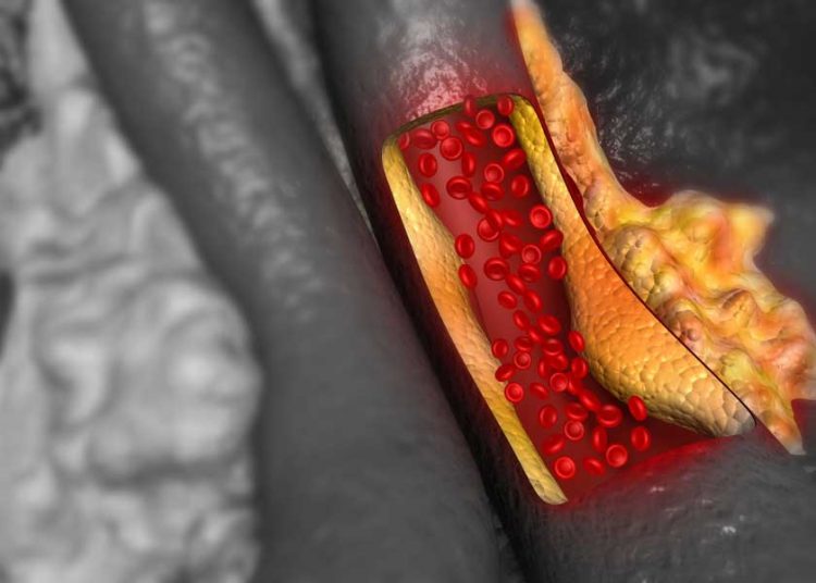 16 Ways to Naturally Reduce High Cholesterol