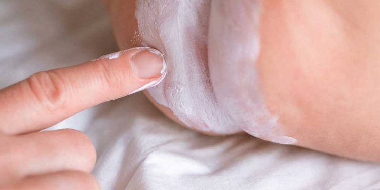 Best Yeast and Diaper Rash Remedies For Your Baby