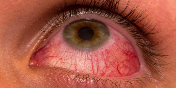 7 Natural and Easy Home Remedies for Red Eyes