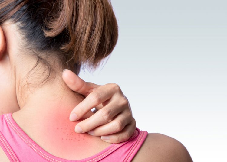 Simple Heat Rash Remedies You Can Try At Home