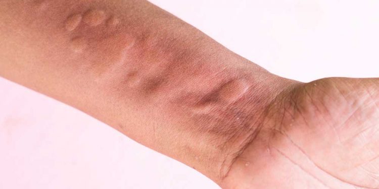 12 Best Home Remedies for Hives For Faster Healing
