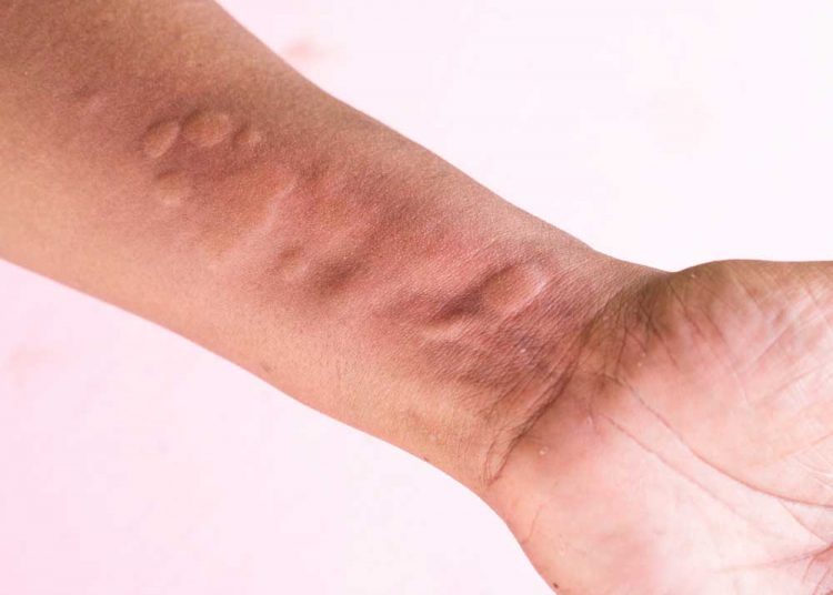 12 Best Home Remedies for Hives For Faster Healing