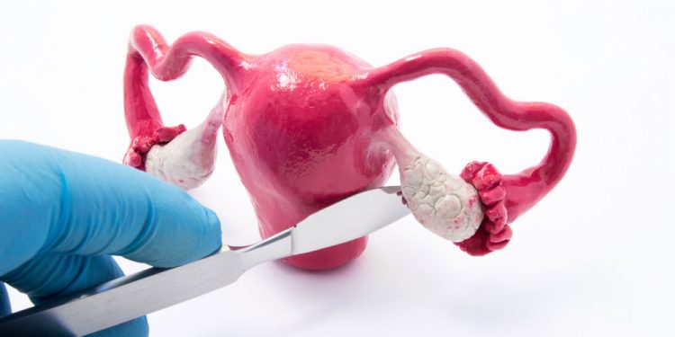 A Simple Cure For Ovarian Cysts and Fibrocystic Breast