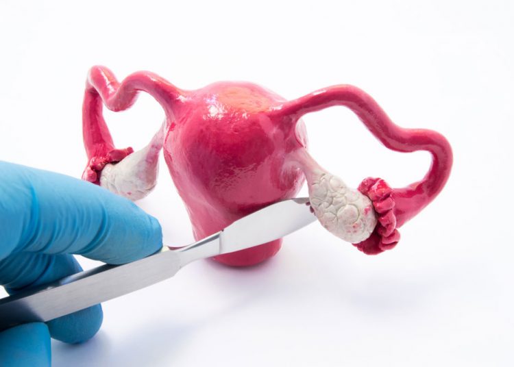 A Simple Cure For Ovarian Cysts and Fibrocystic Breast