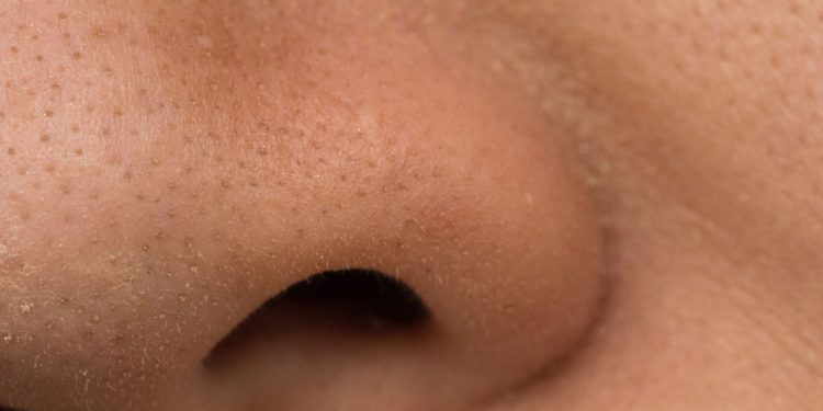 14 Best Natural Remedies to Get Rid of Whiteheads