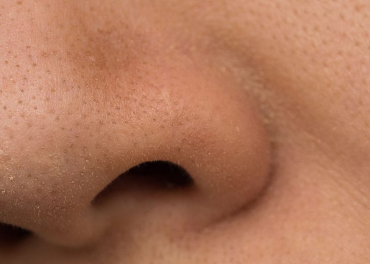 14 Best Natural Remedies to Get Rid of Whiteheads