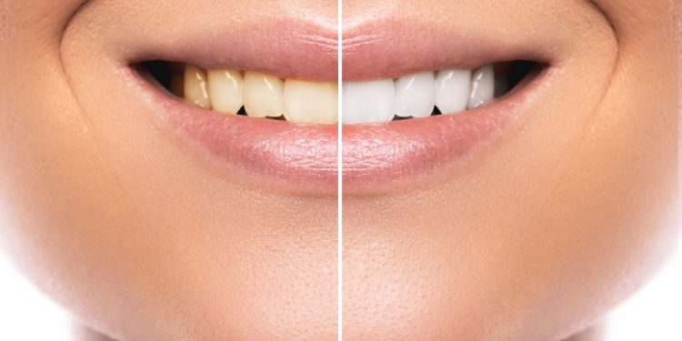 9 Safe and Natural Ways to Whiten Your Teeth