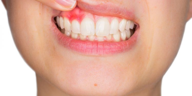 10 Natural Home Remedies to Get Rid of Abscessed Tooth