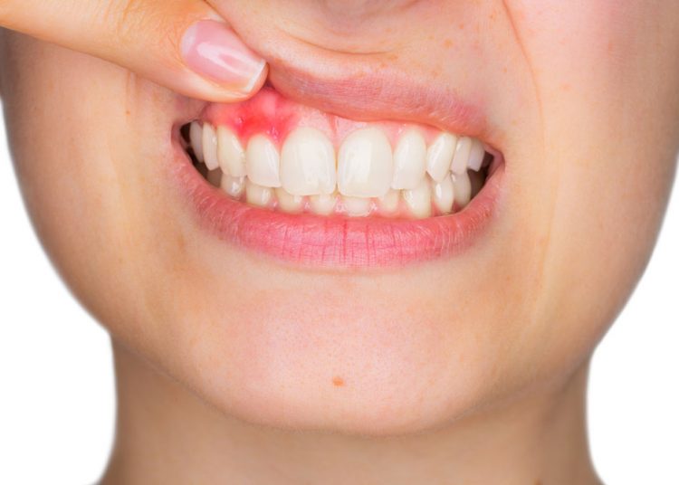 10 Natural Home Remedies to Get Rid of Abscessed Tooth