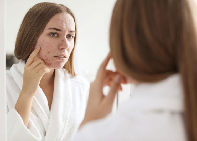 9 Natural Remedies for Acne During Pregnancy