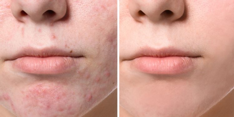 5 Simple ways To Use Lemon Juice To Clear off Acne