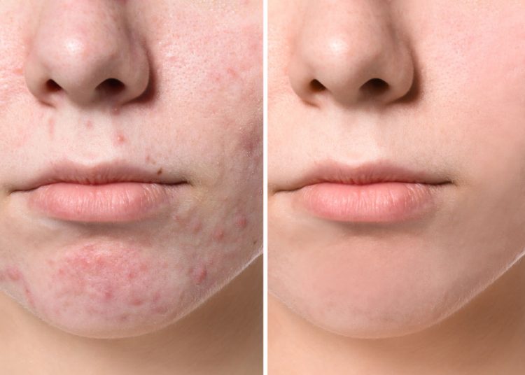 5 Simple ways To Use Lemon Juice To Clear off Acne