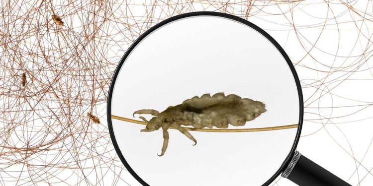 6 Best Home Remedies to Get Rid of Head Lice