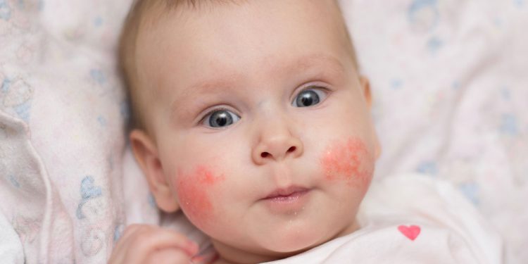 7 Natural Eczema Remedies For Kids And Adults