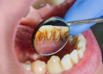 10 Simple Home Remedies for Gingivitis You Must Know
