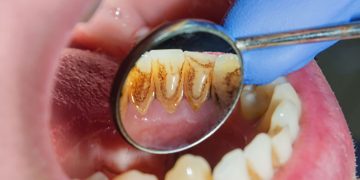 10 Simple Home Remedies for Gingivitis You Must Know