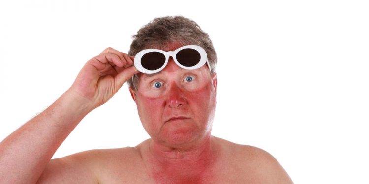 8 Quick Remedies to Treat Sunburn