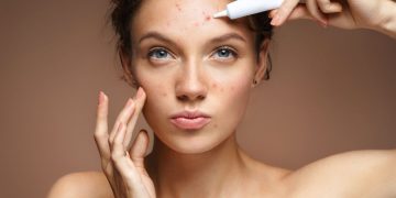 How to Clear Pimples Using Toothpaste