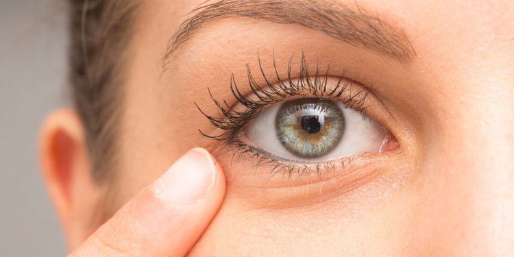 5 Best Ways To Get Rid Of Under Eye Wrinkles