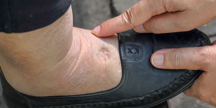 6 Best Ways To Reduce Water Retention