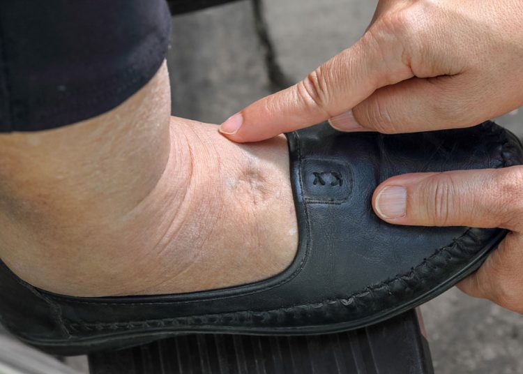 6 Best Ways To Reduce Water Retention