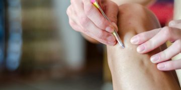 8 Simple Remedies To Prevent Ingrown Hairs