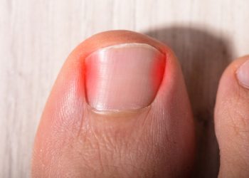 5 Easy Remedies to Ease Ingrown Toenails