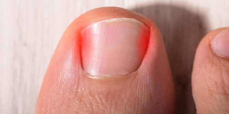5 Easy Remedies to Ease Ingrown Toenails